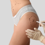 manual lymph drainage